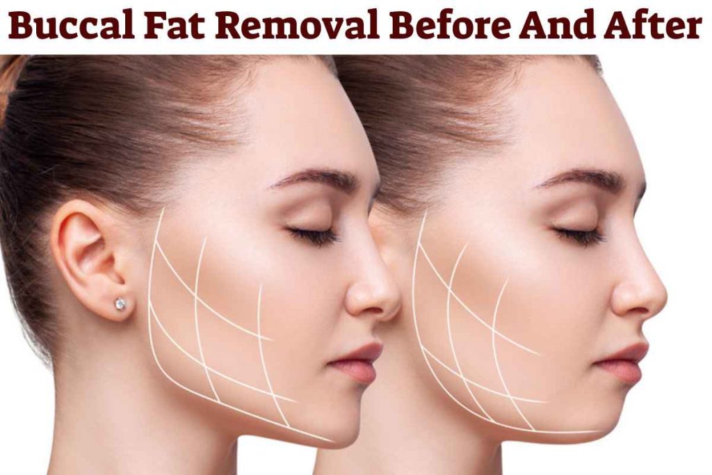 Buccal Fat Removal