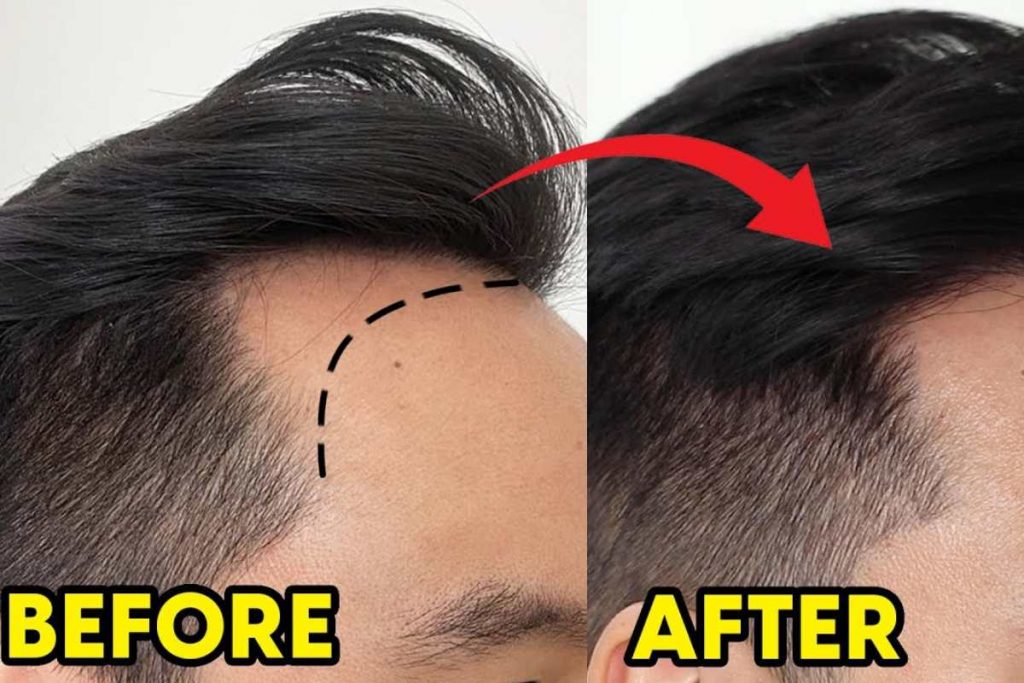 Hair Transplant Before And After
