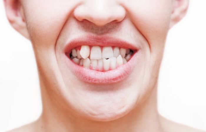 What Is The Treatment Of Jagged Teeth?