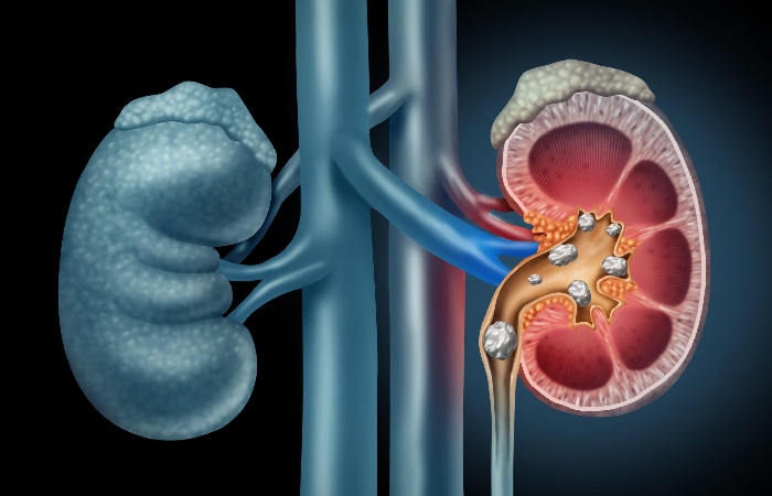 9. Reduces The Risk Of Kidney Stones