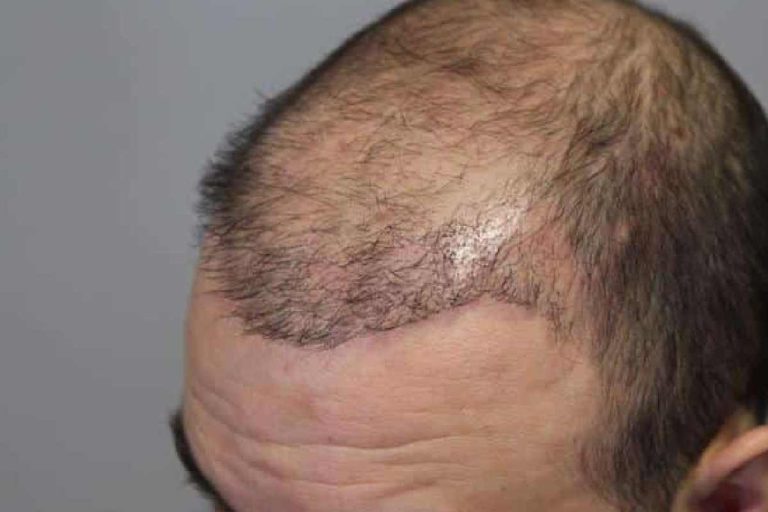 Failed Hair Transplant