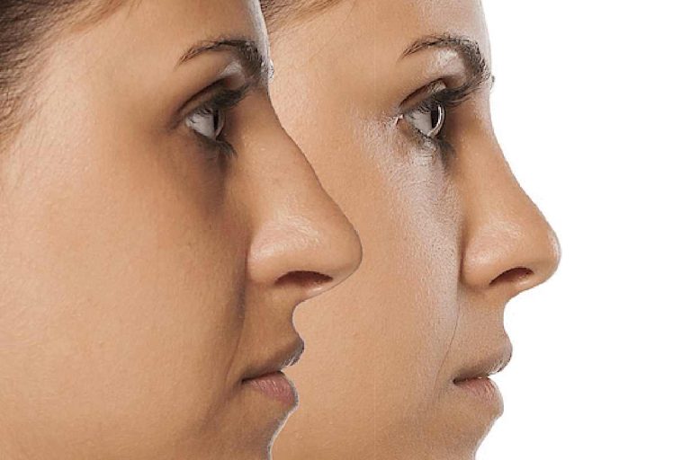 Nose Reshaping vs Breathing Easy
