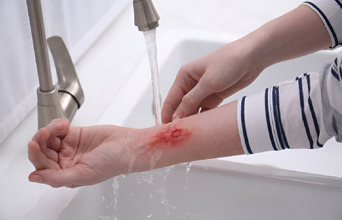Acid and Chemical Burns