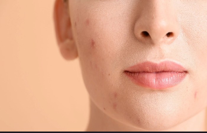 Acne Treatment Write For Us 