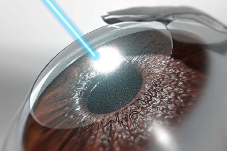 From Consultation to Clear Vision: Your Step-by-Step Guide to LASIK Surgery LASIK Surgery